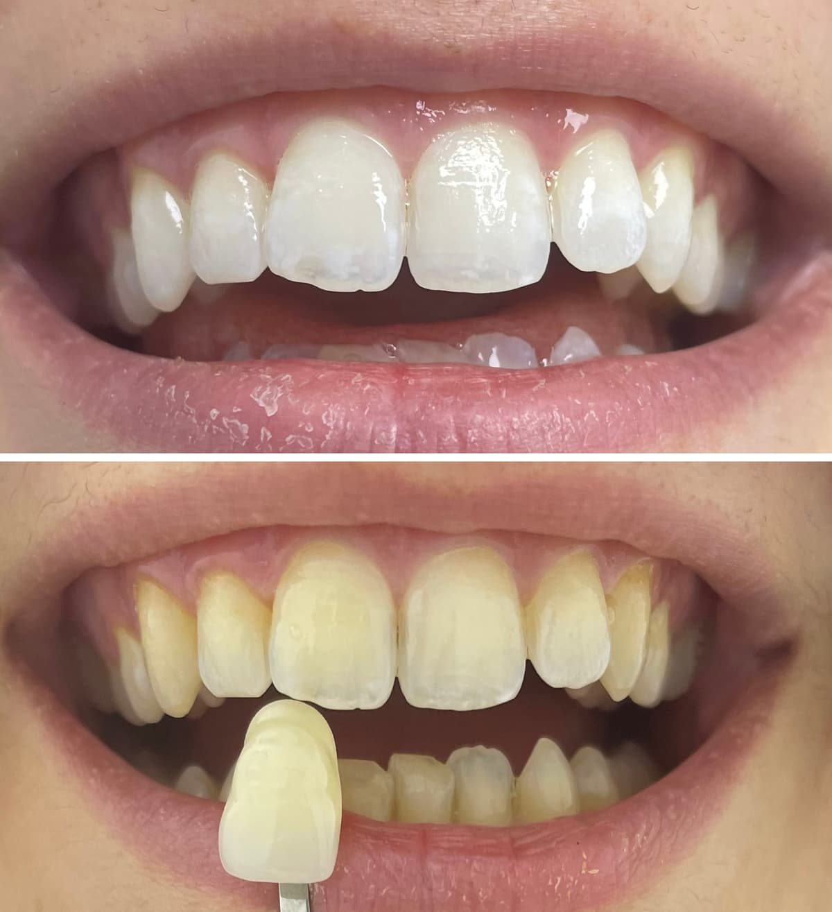 Tooth Whitening image used.